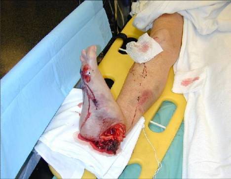 Ankle-Leg Trauma