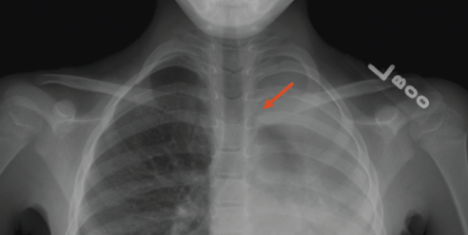tracheobronchial+foreign+body+aspiration