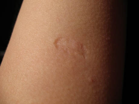 smallpox-vaccination-scar
